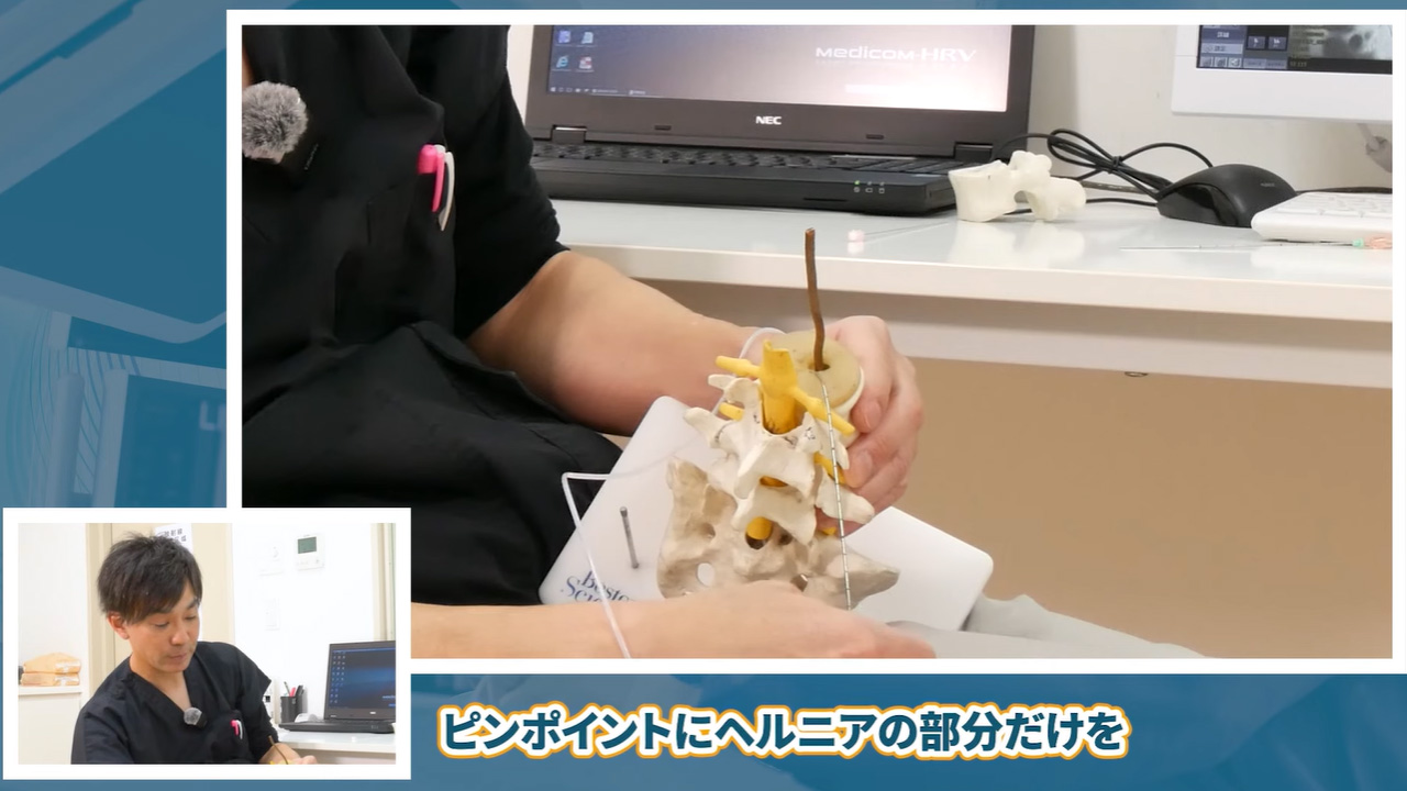 ピンポイントにヘルニアを焼灼