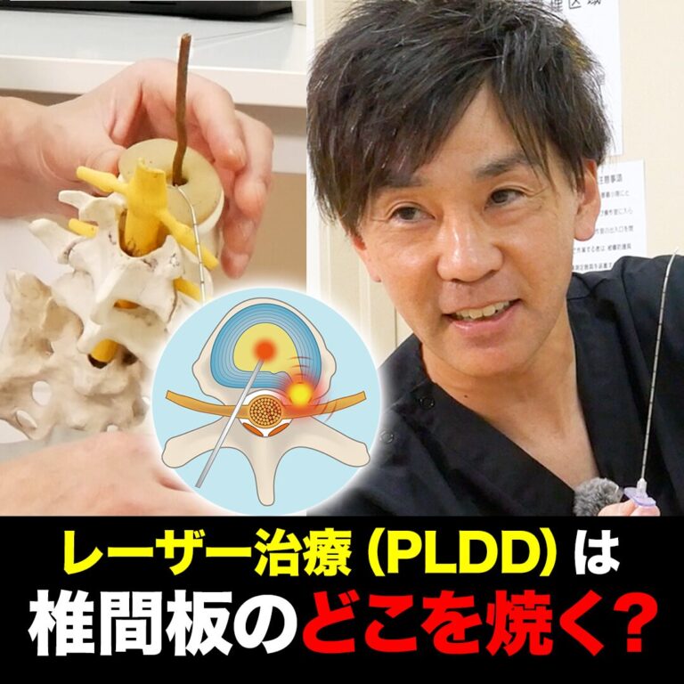 PLDD（レーザー治療）は椎間板のどこを焼く？野中腰痛クリニックの治療への「こだわり」を解説
