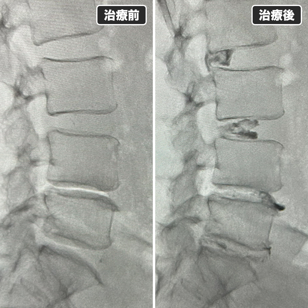 治療前後のレントゲン
