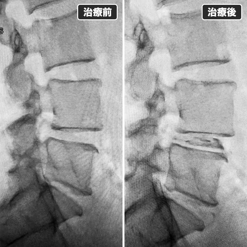 治療前後のレントゲン