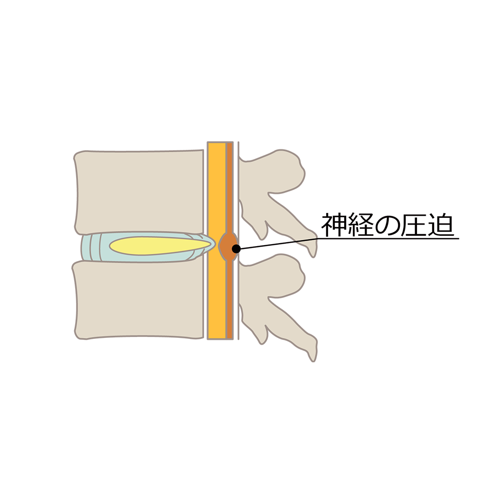 神経の圧迫