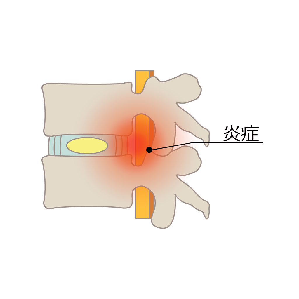 椎間板の炎症