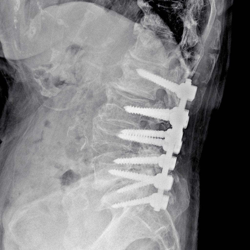 固定術のレントゲン画像