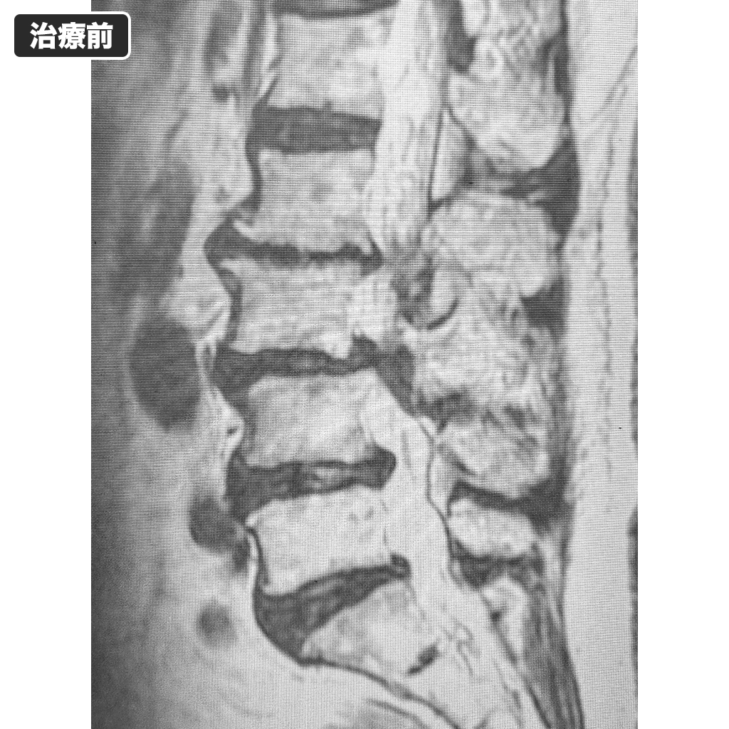 MRI:治療前