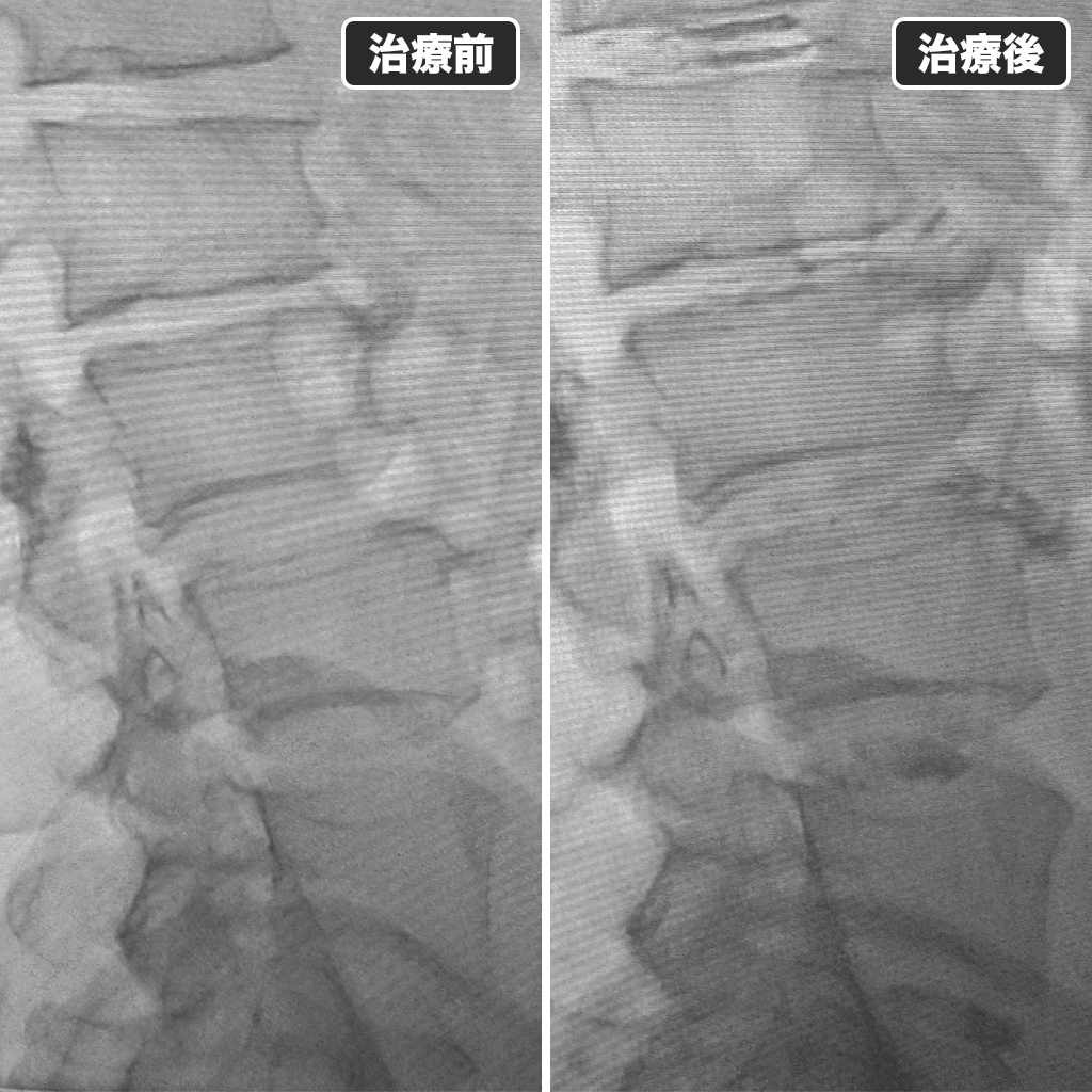 治療前後のレントゲン