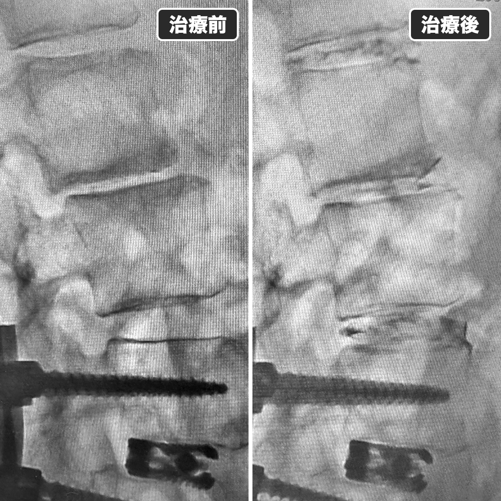 治療前後のレントゲン写真