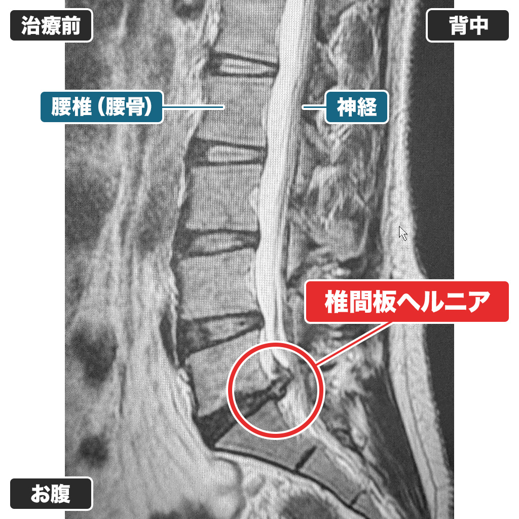 MRI：治療前