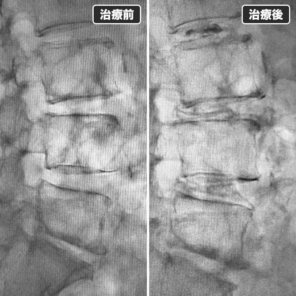 治療前後のレントゲン写真