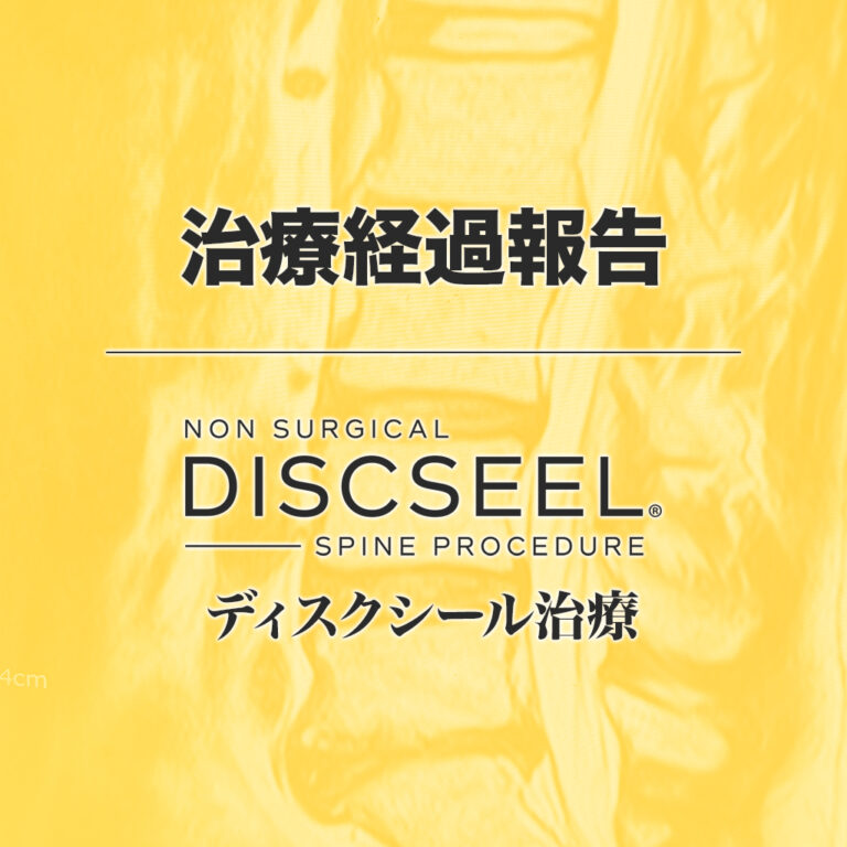 治療後1年・・腰痛発作が出現（ゴルフ好きな50代男性の場合）