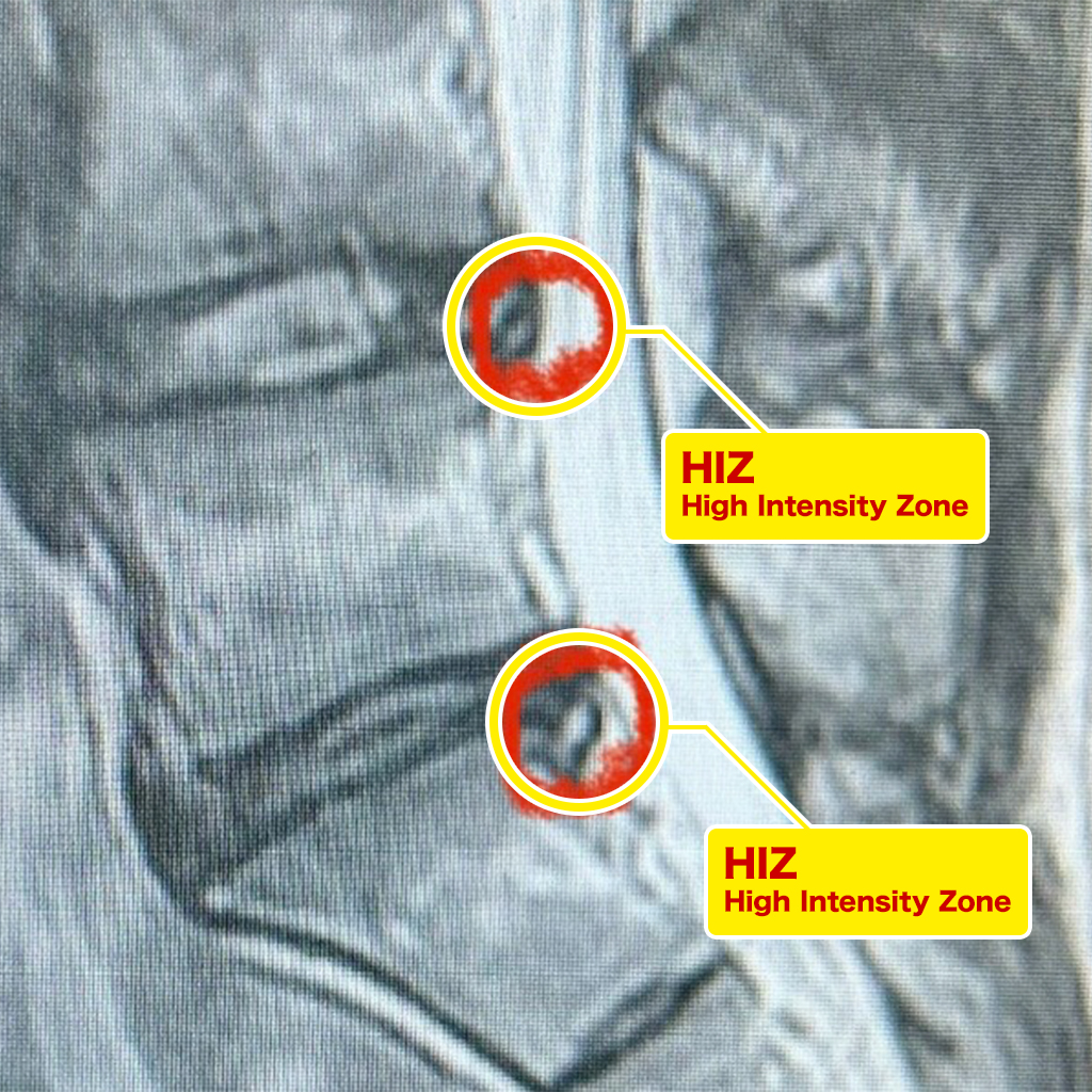 HIZ(High Intensity Zone)