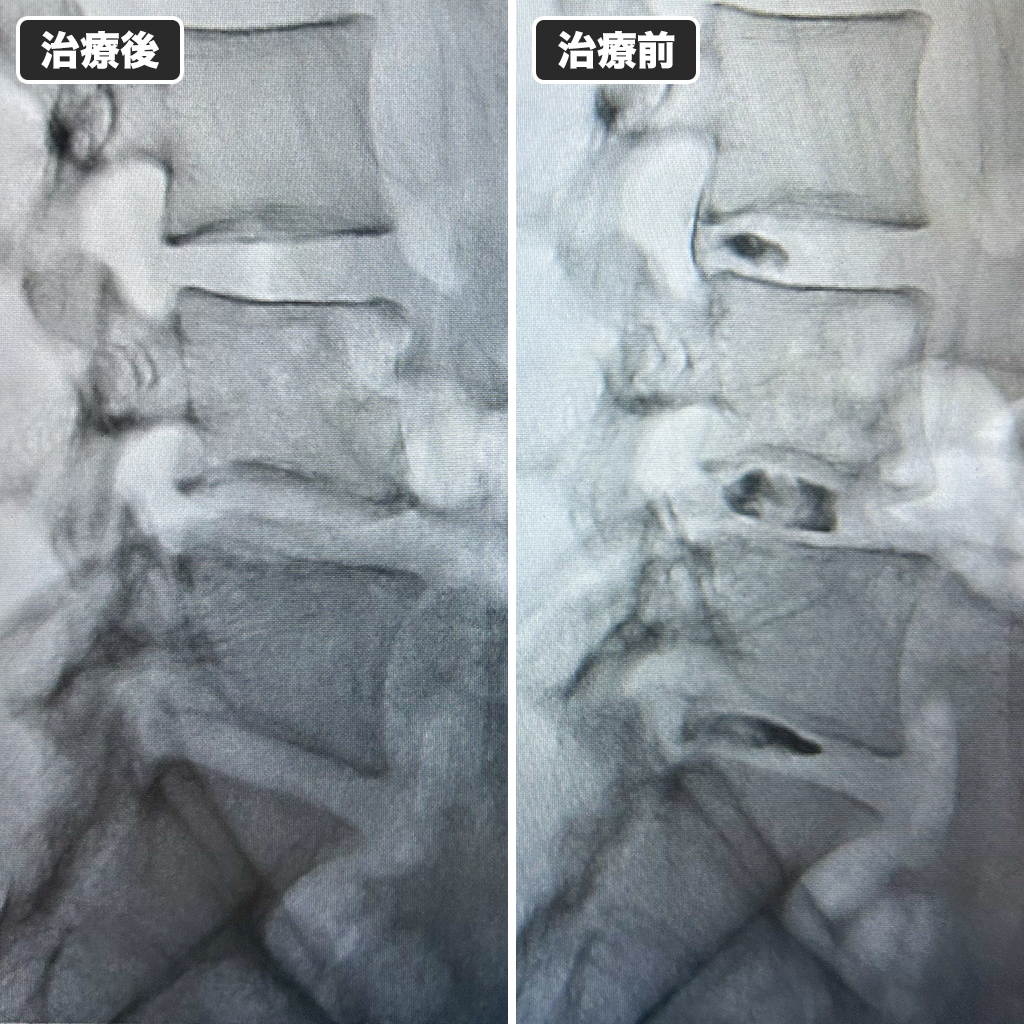 治療前後のレントゲン写真