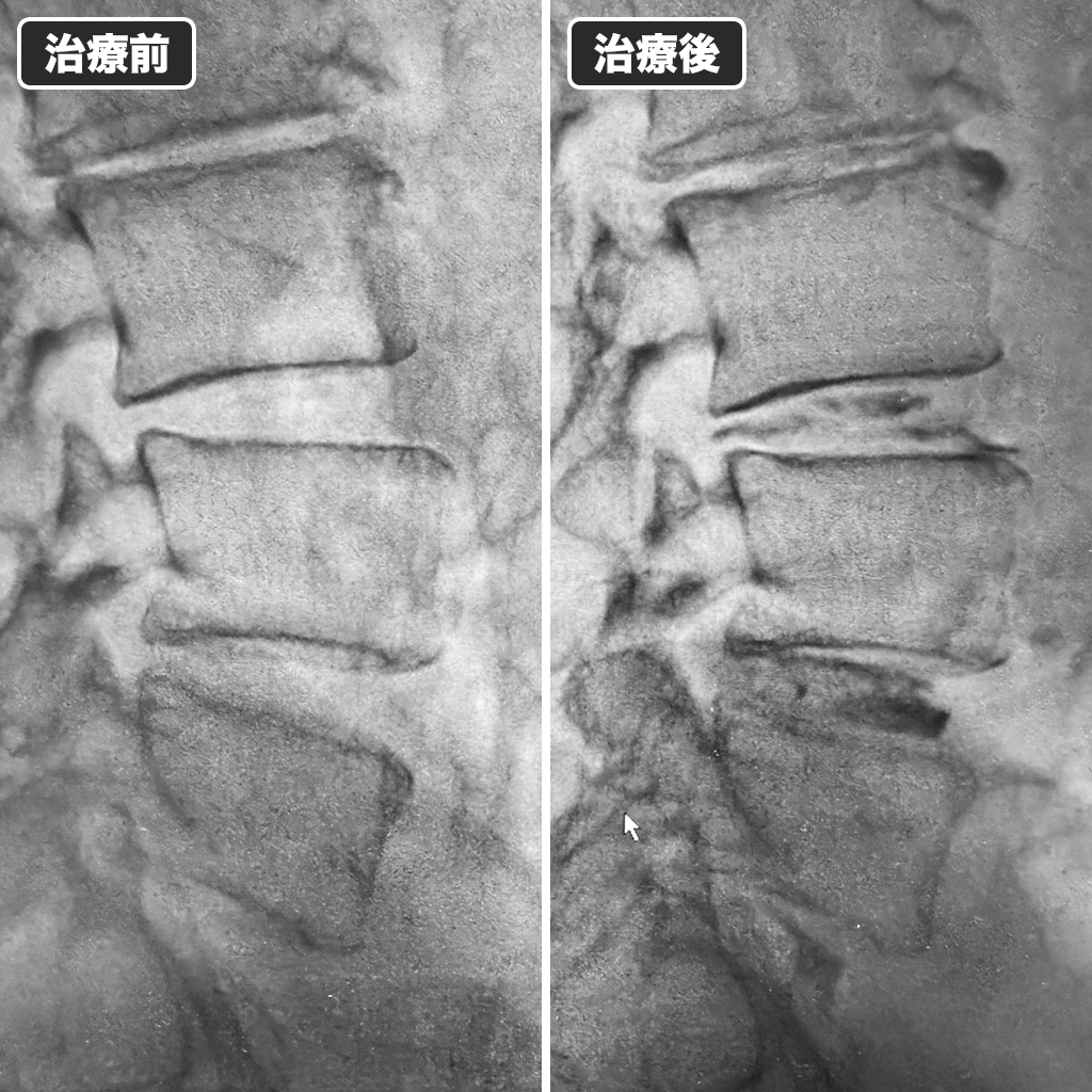 治療前後のレントゲン写真