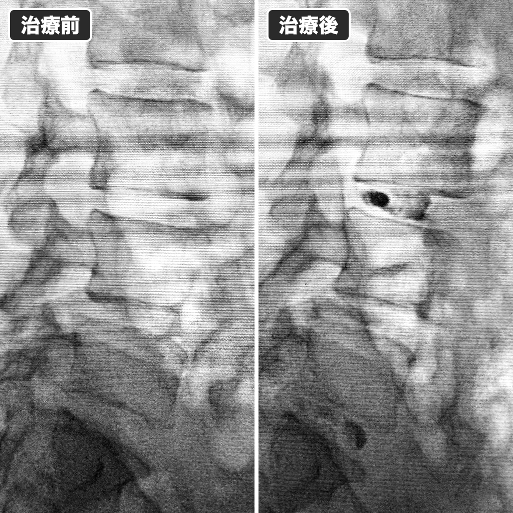 治療前後のレントゲン写真