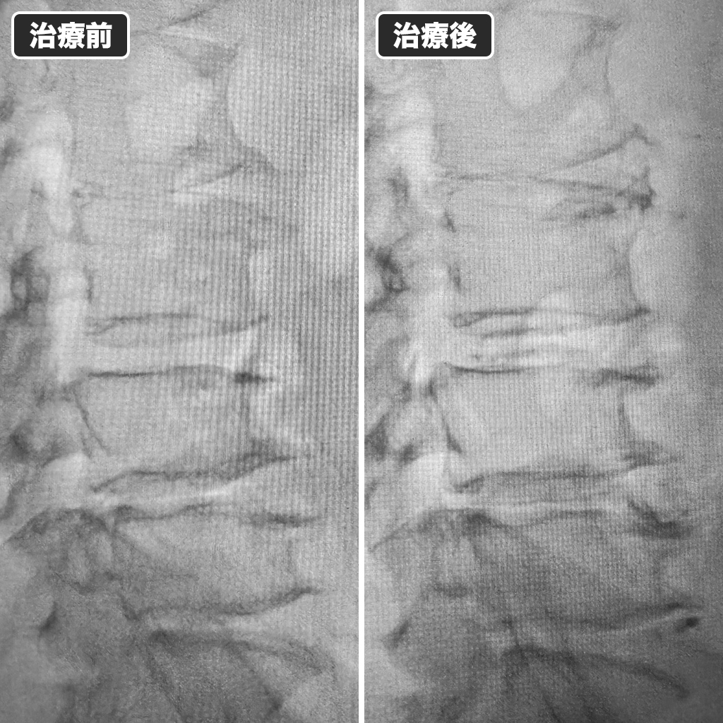 治療前後のレントゲン写真