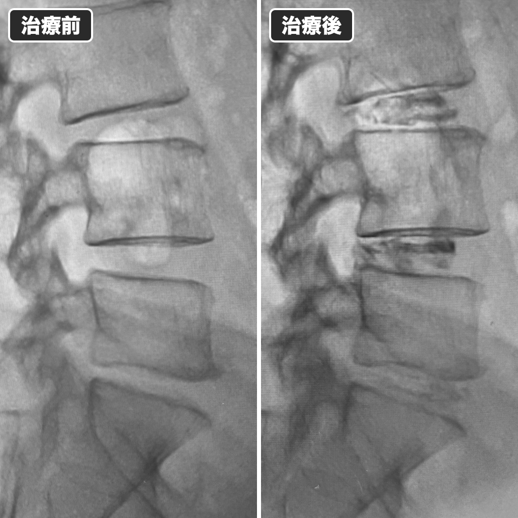 治療前後のレントゲン写真