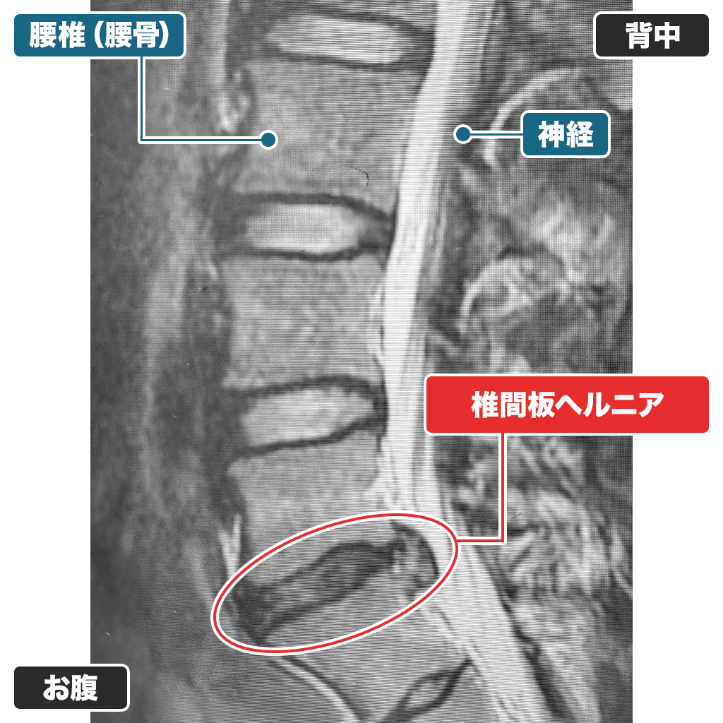 MRI：治療前
