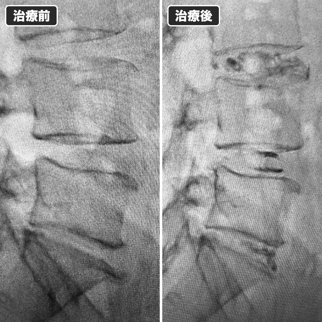 治療前後のレントゲン写真