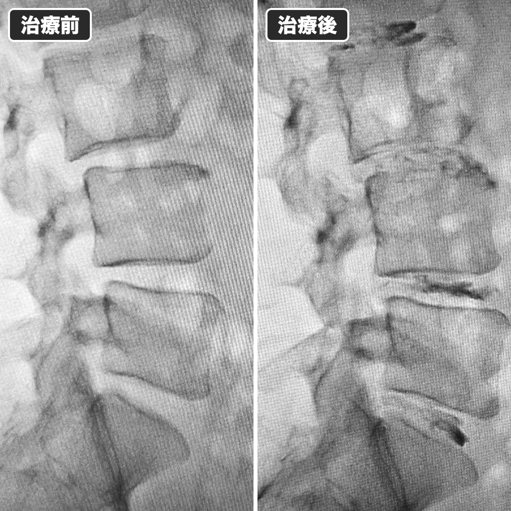 治療前後のレントゲン写真