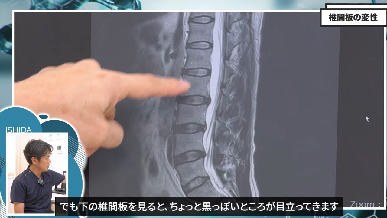 椎間板が黒くなっている