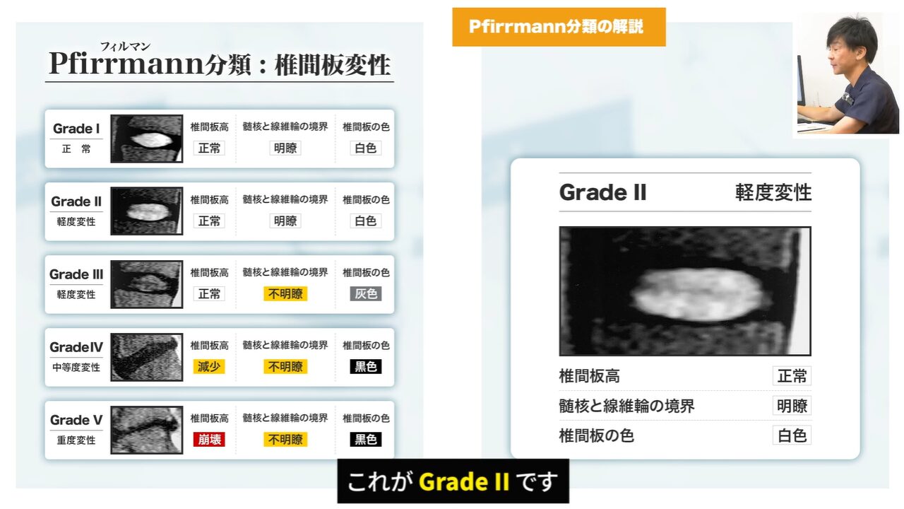 症状初期の椎間板