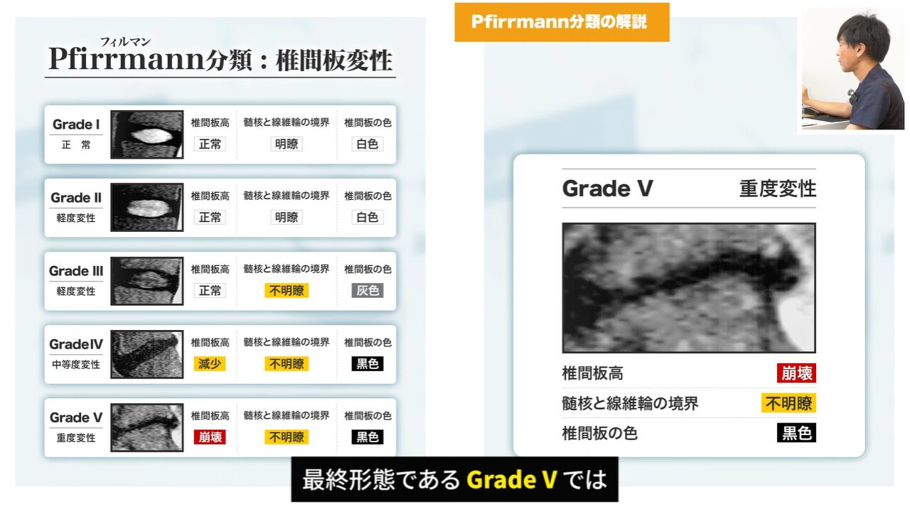 椎間板に亀裂が発生している椎間板