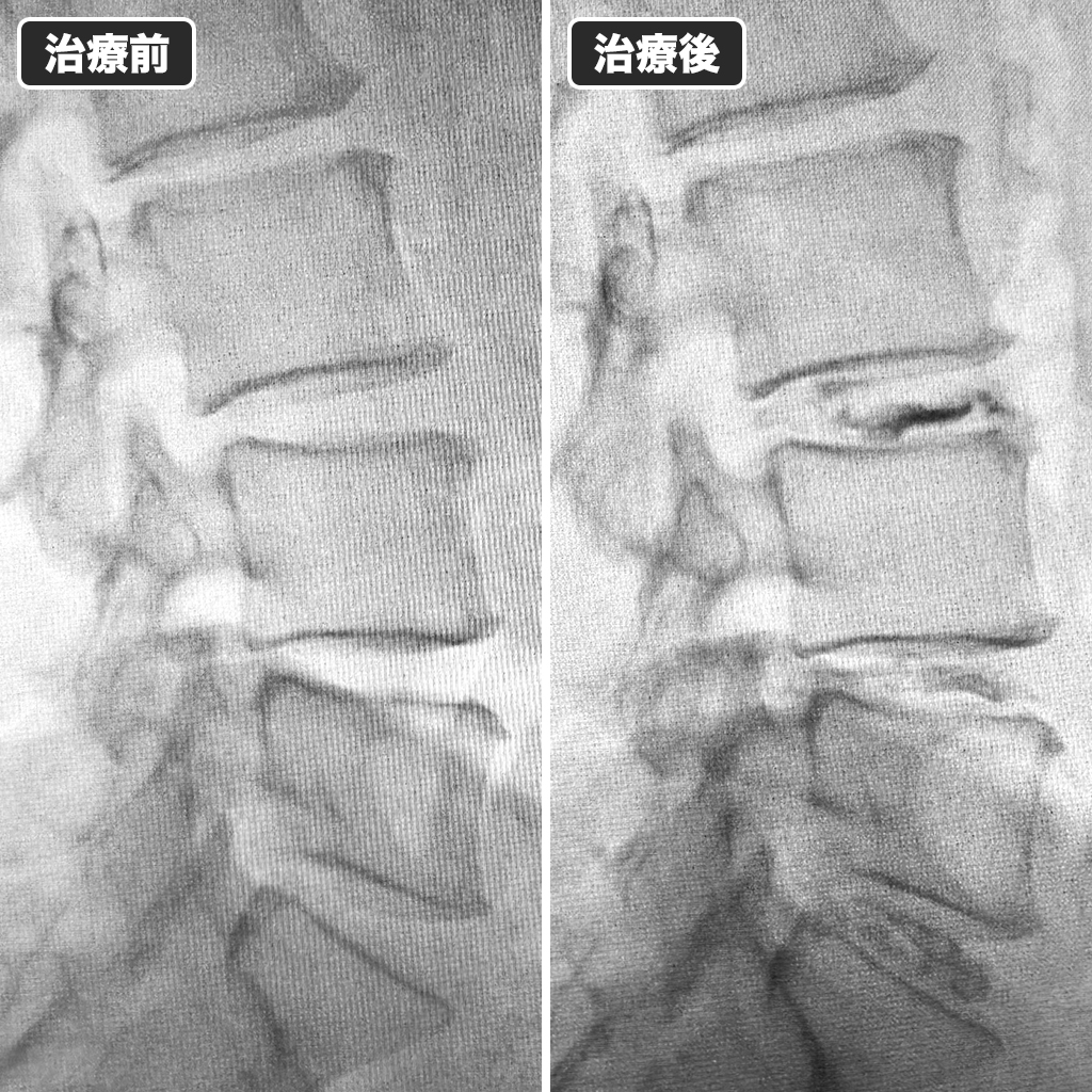 治療前後のレントゲン写真