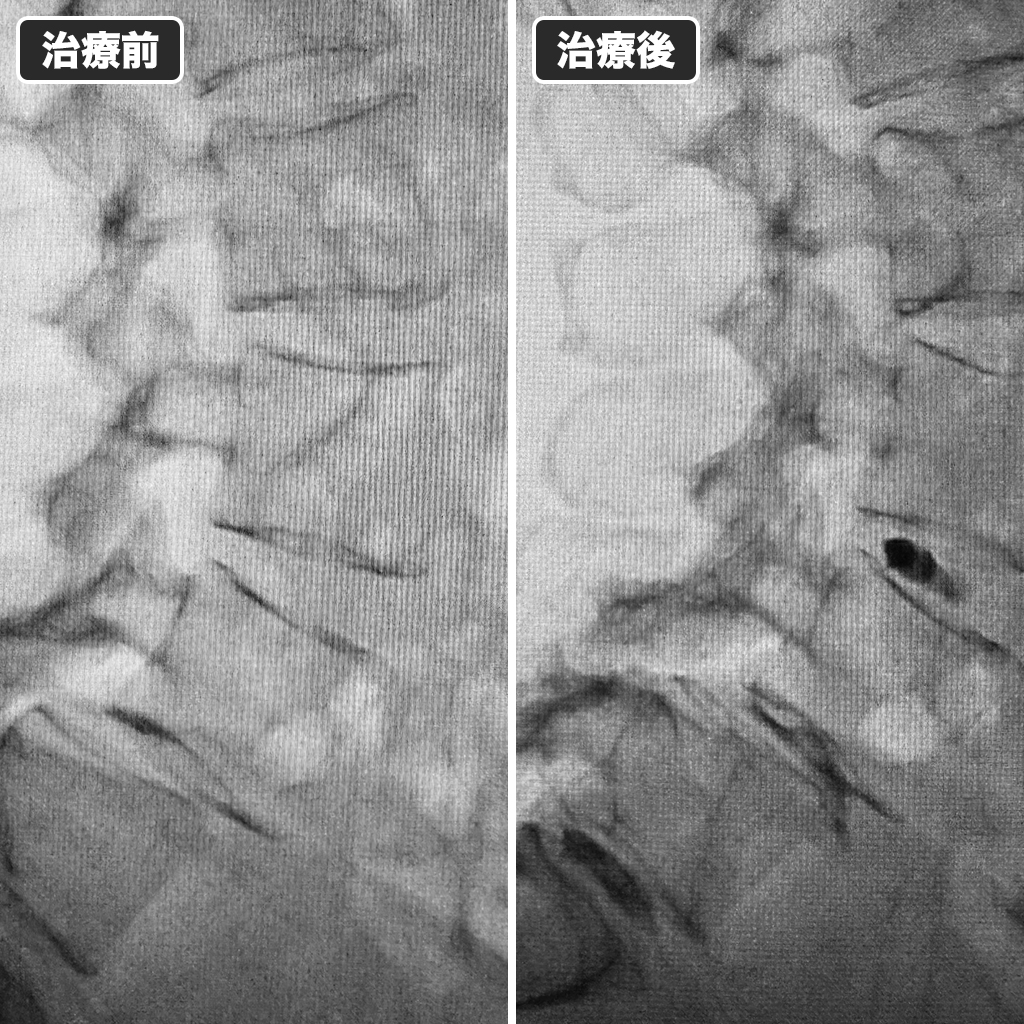 治療前後のレントゲン写真