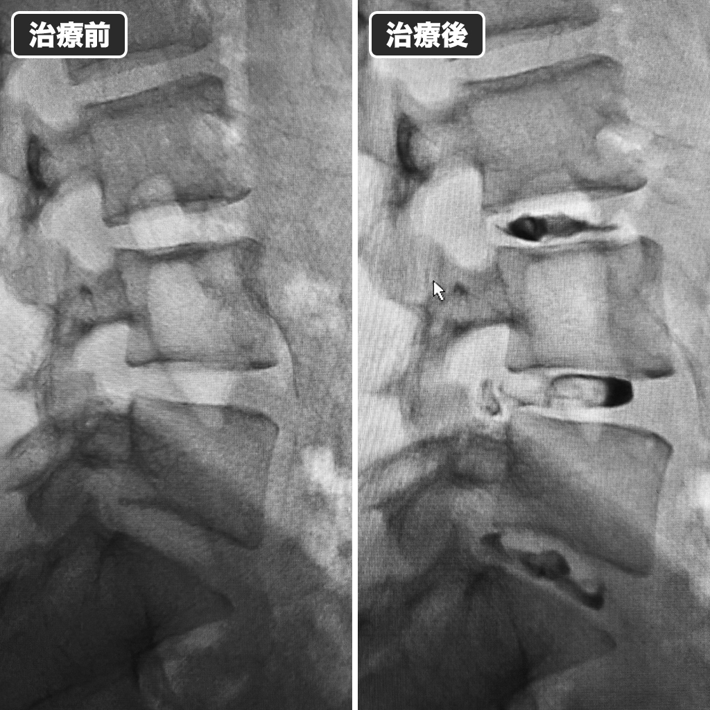 治療前後のレントゲン写真
