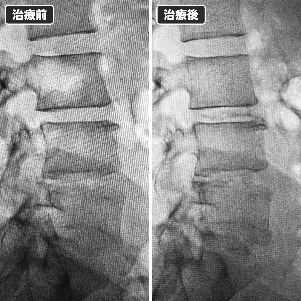 治療前後のレントゲン写真