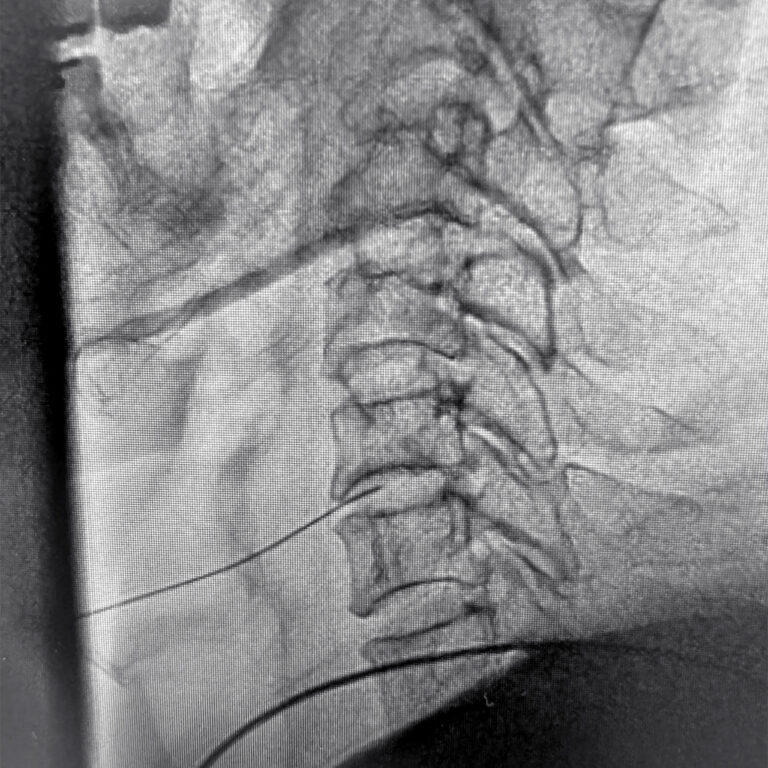 頸椎治療の難易度は？