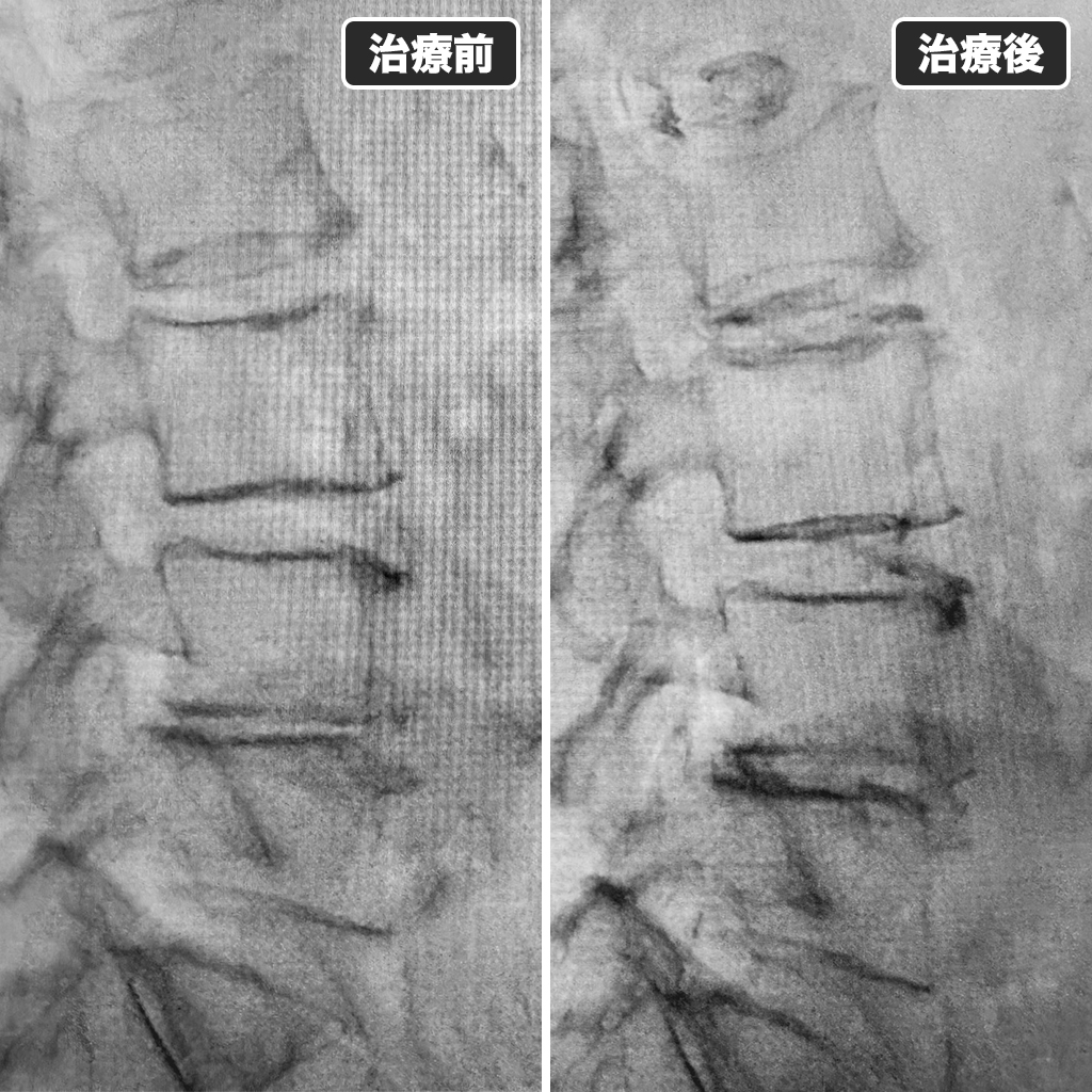 治療前後のレントゲン写真