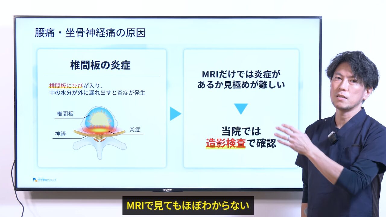 椎間板の炎症について