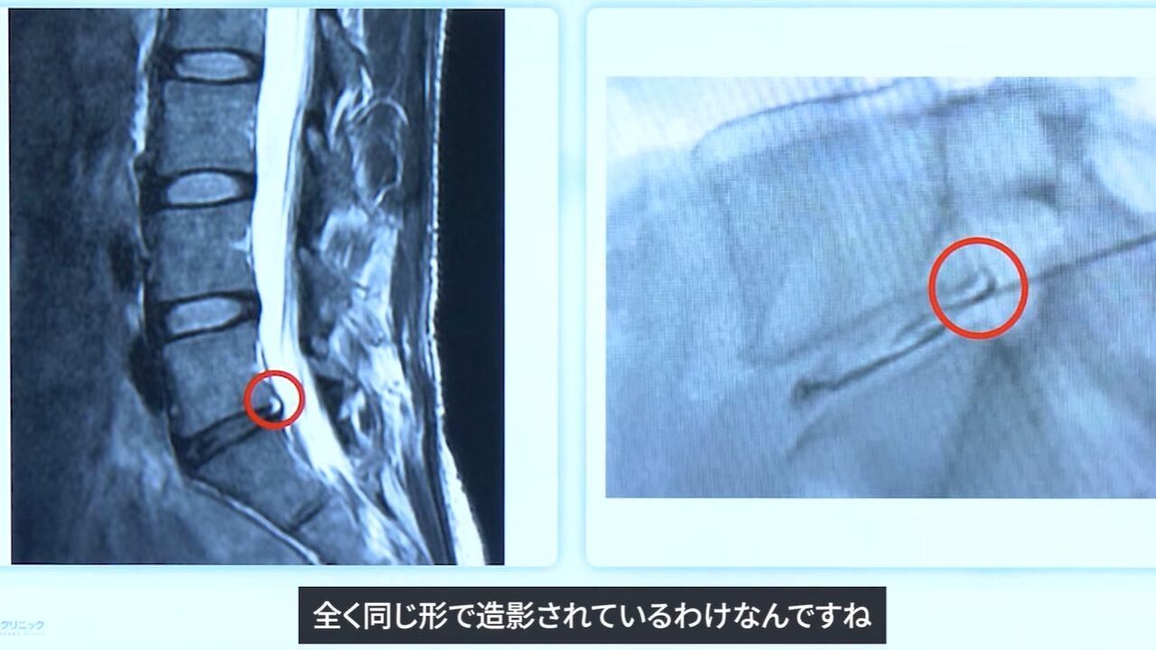 症例①HIZとMRI画像の比較