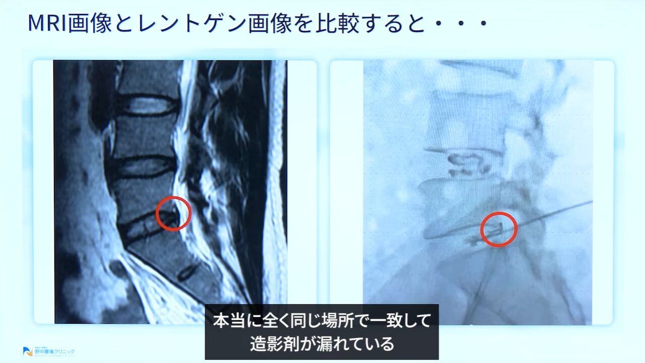 症例②HIZとMRI画像の比較