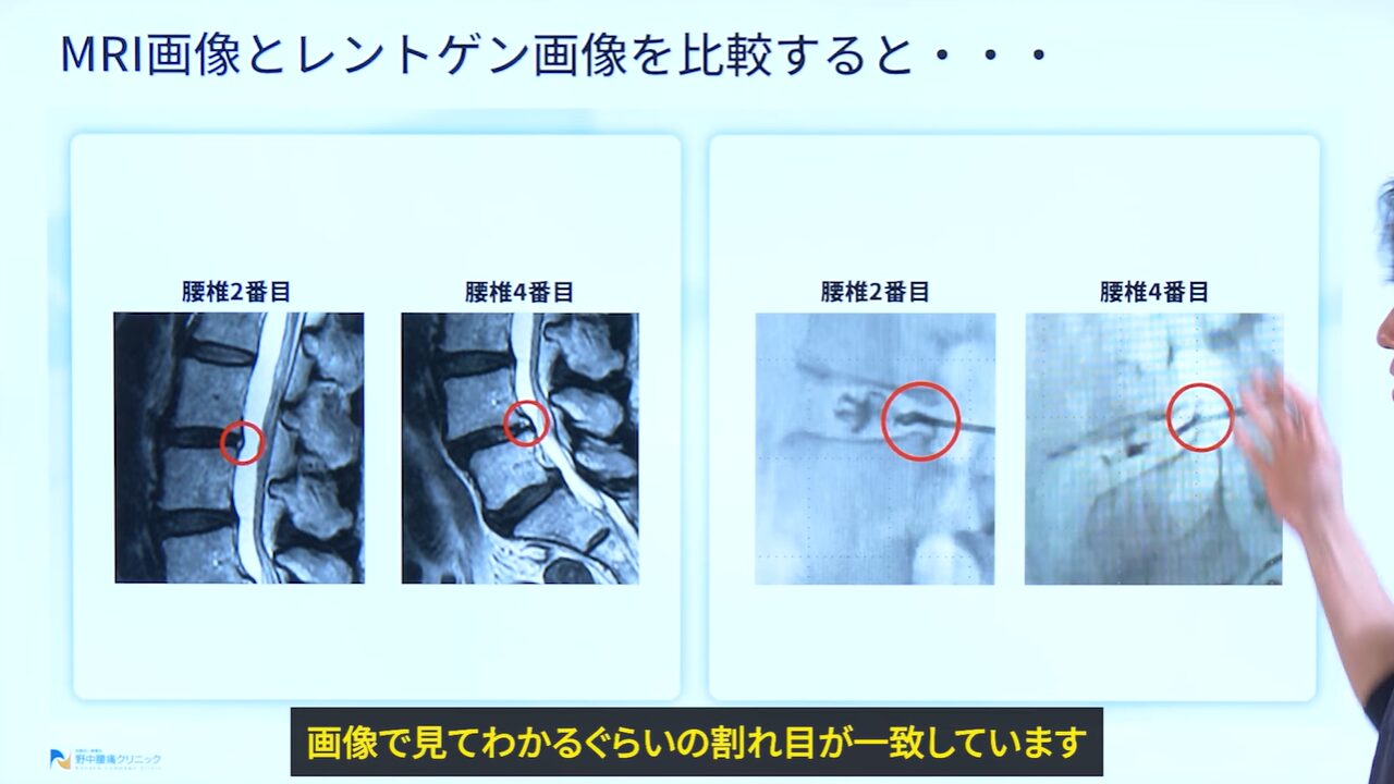 症例③HIZとMRI画像の比較