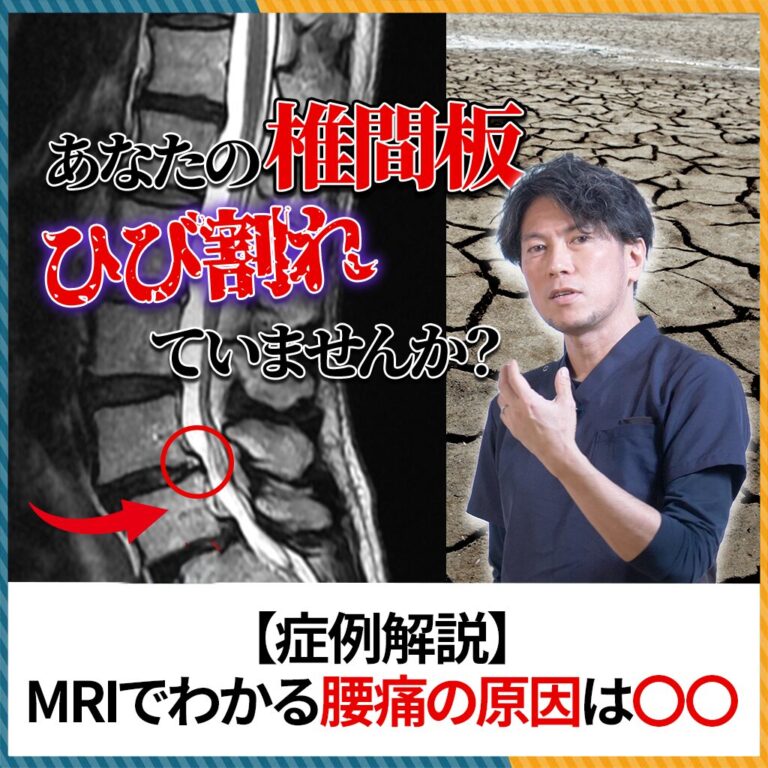 【腰痛の原因はこれかも？】MRIで白く光る「HIZ」とは？隠れた椎間板のひび割れを実症例で解説