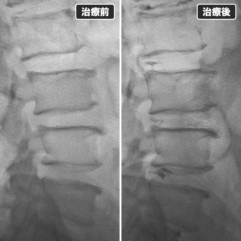 治療前後のレントゲン写真