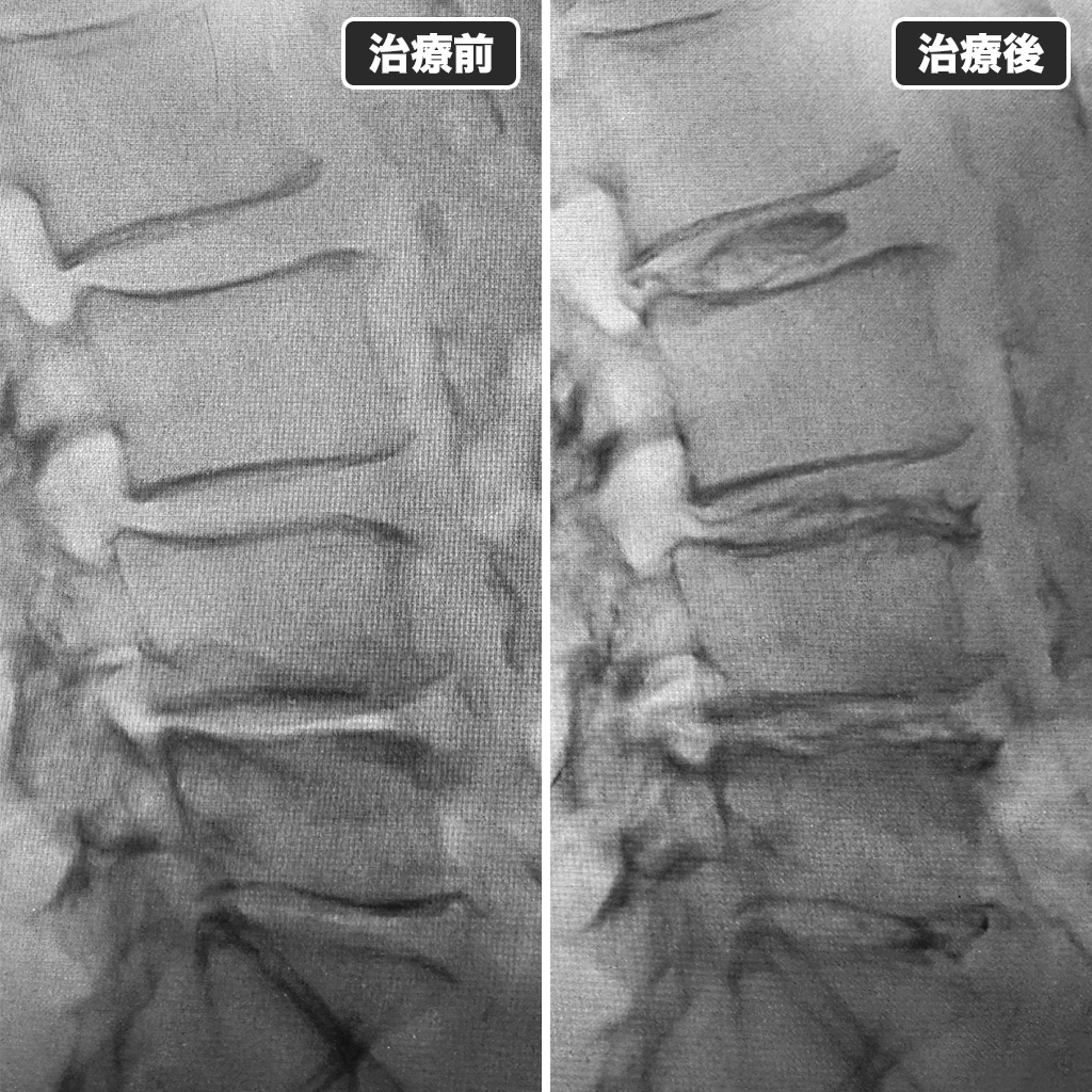治療前後のレントゲン写真
