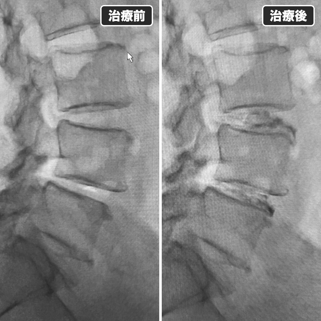 治療前後のレントゲン写真