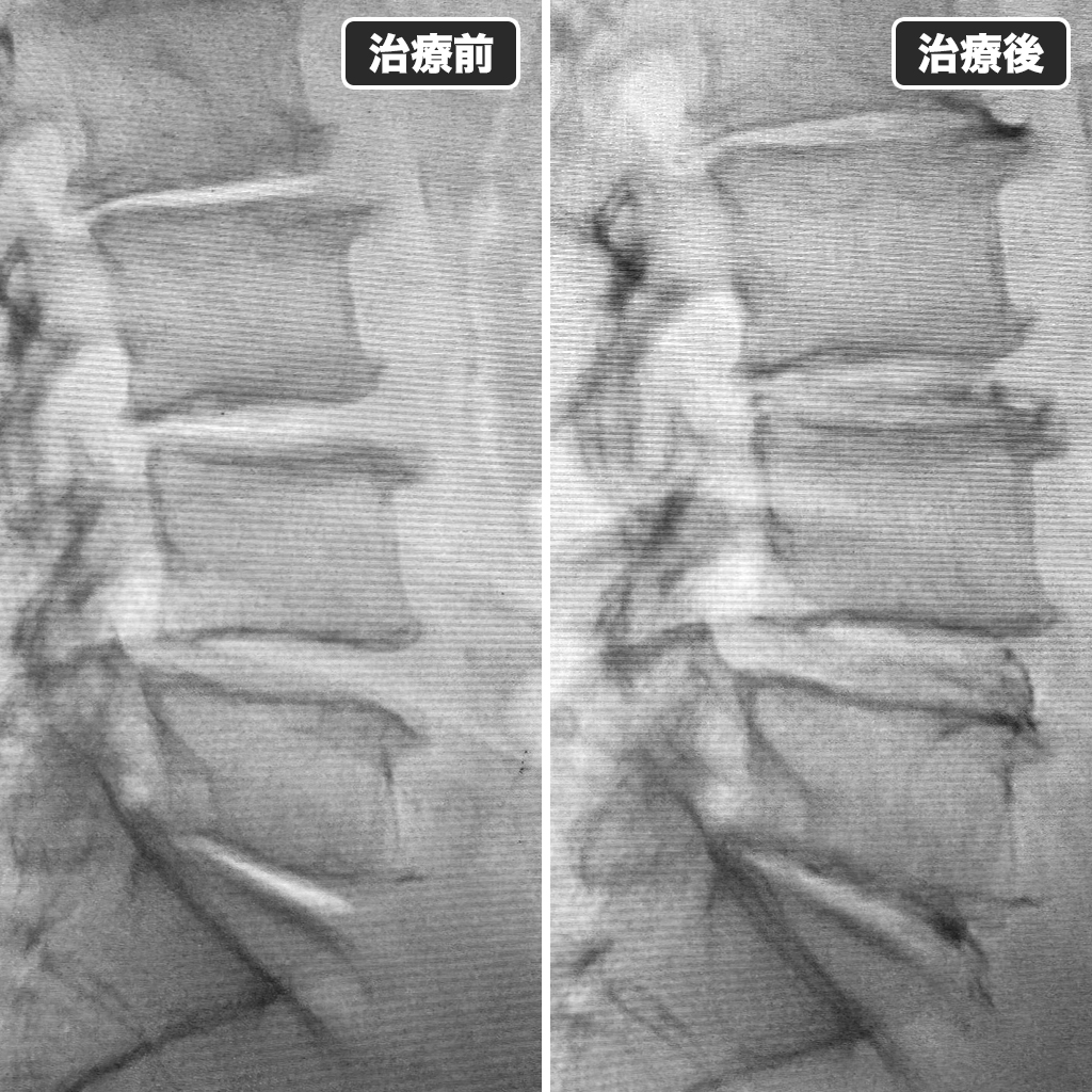 治療前後のレントゲン写真