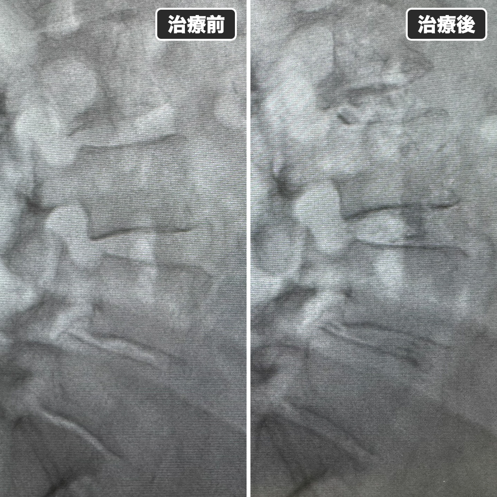 治療前後のレントゲン写真