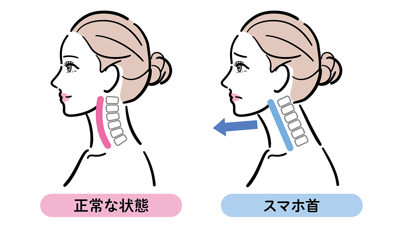正常な首とスマホ首
