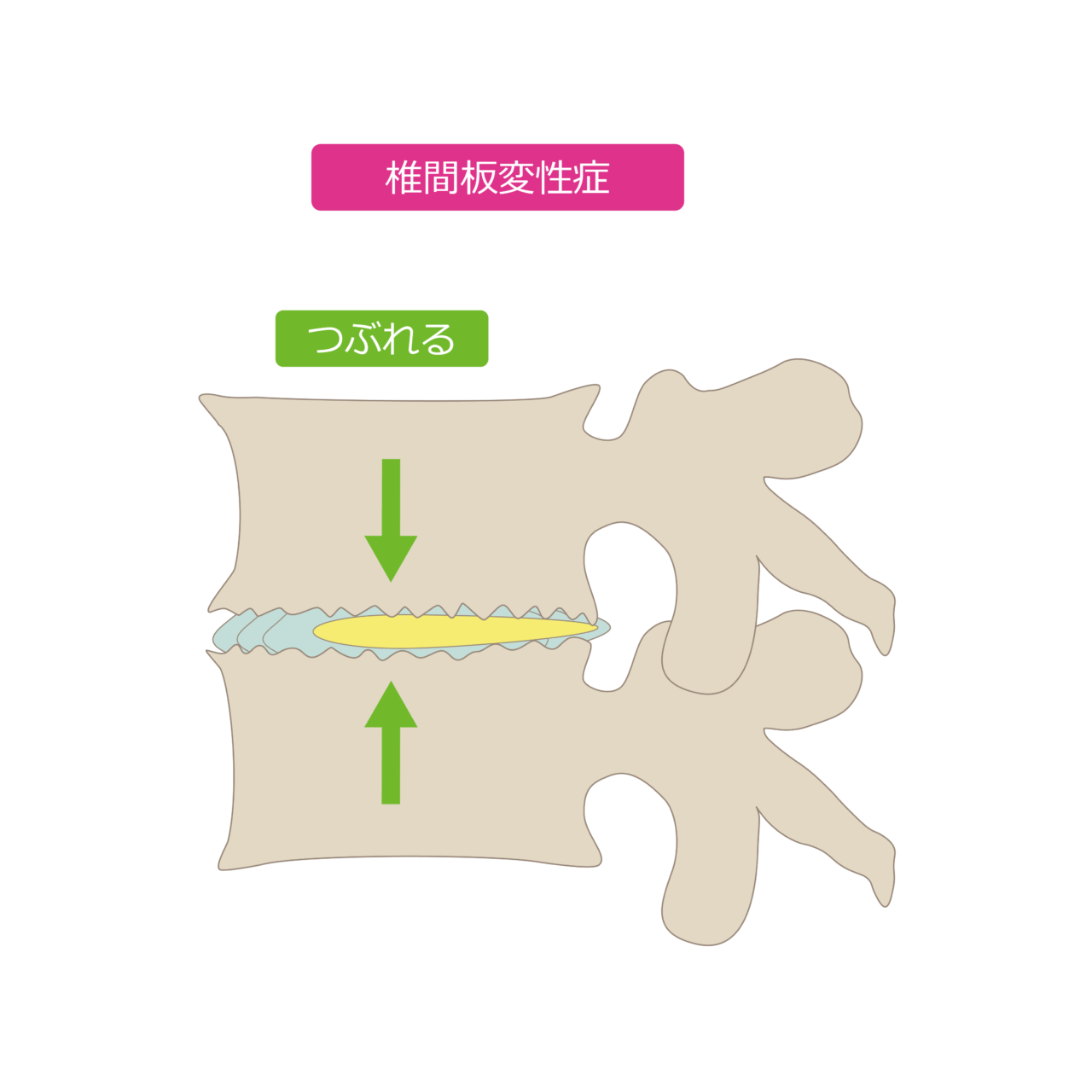 椎間板変性症