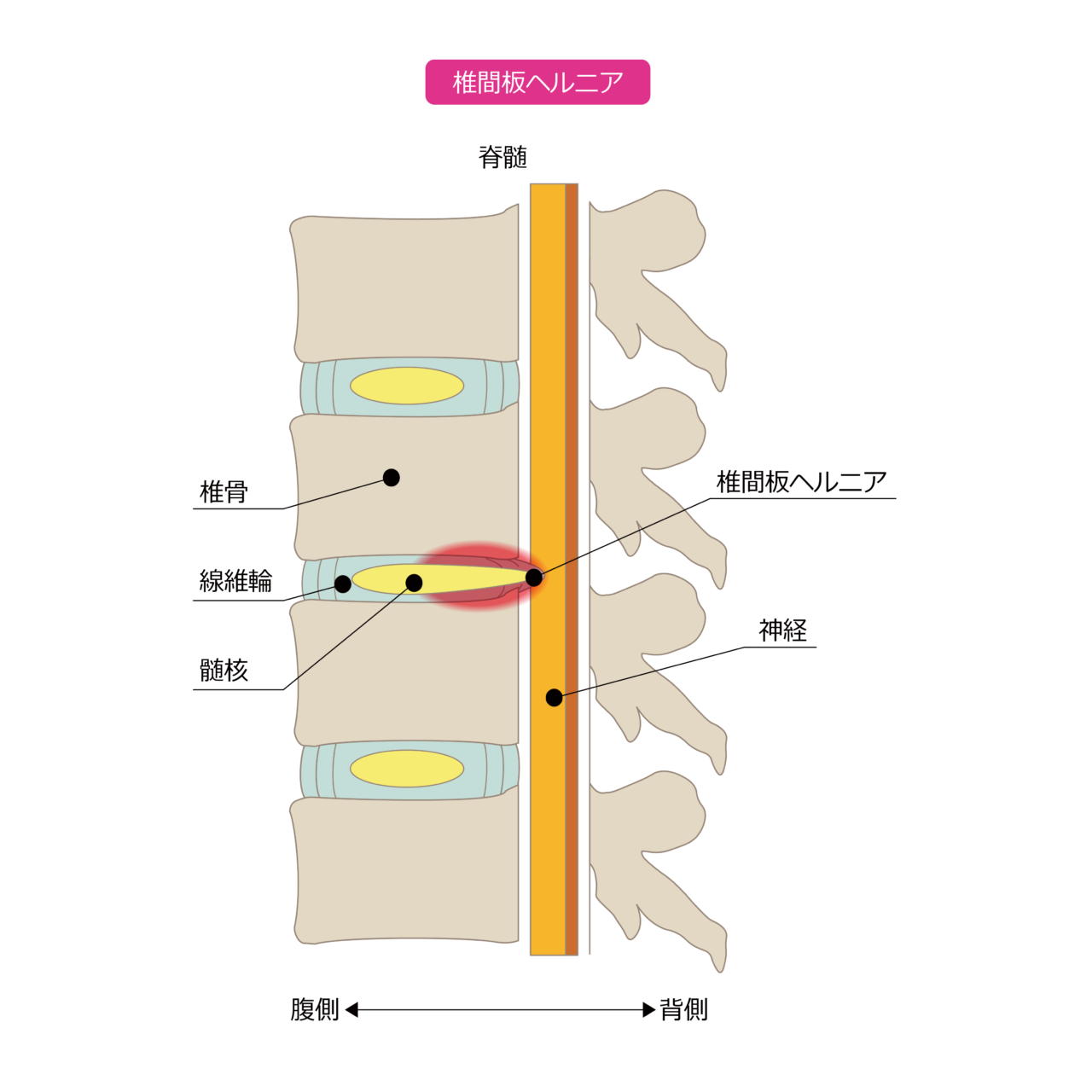椎間板ヘルニア