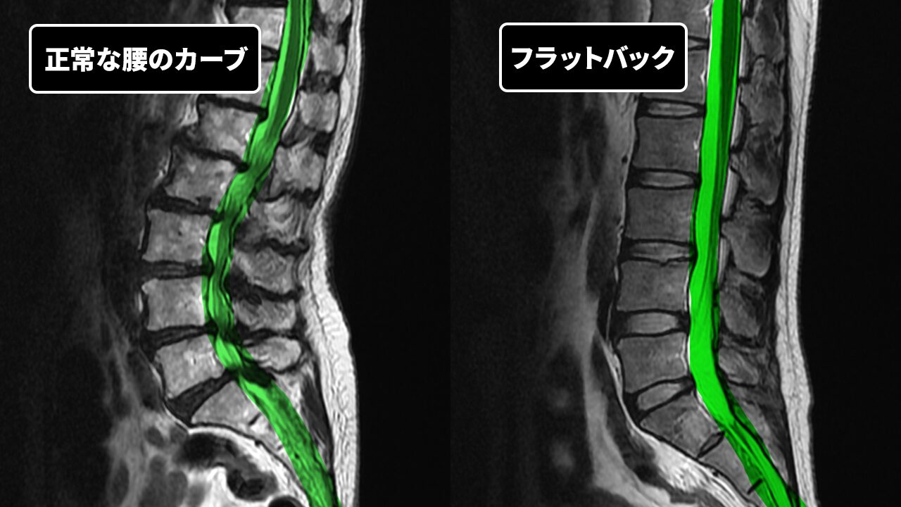 正常な腰とフラットバック