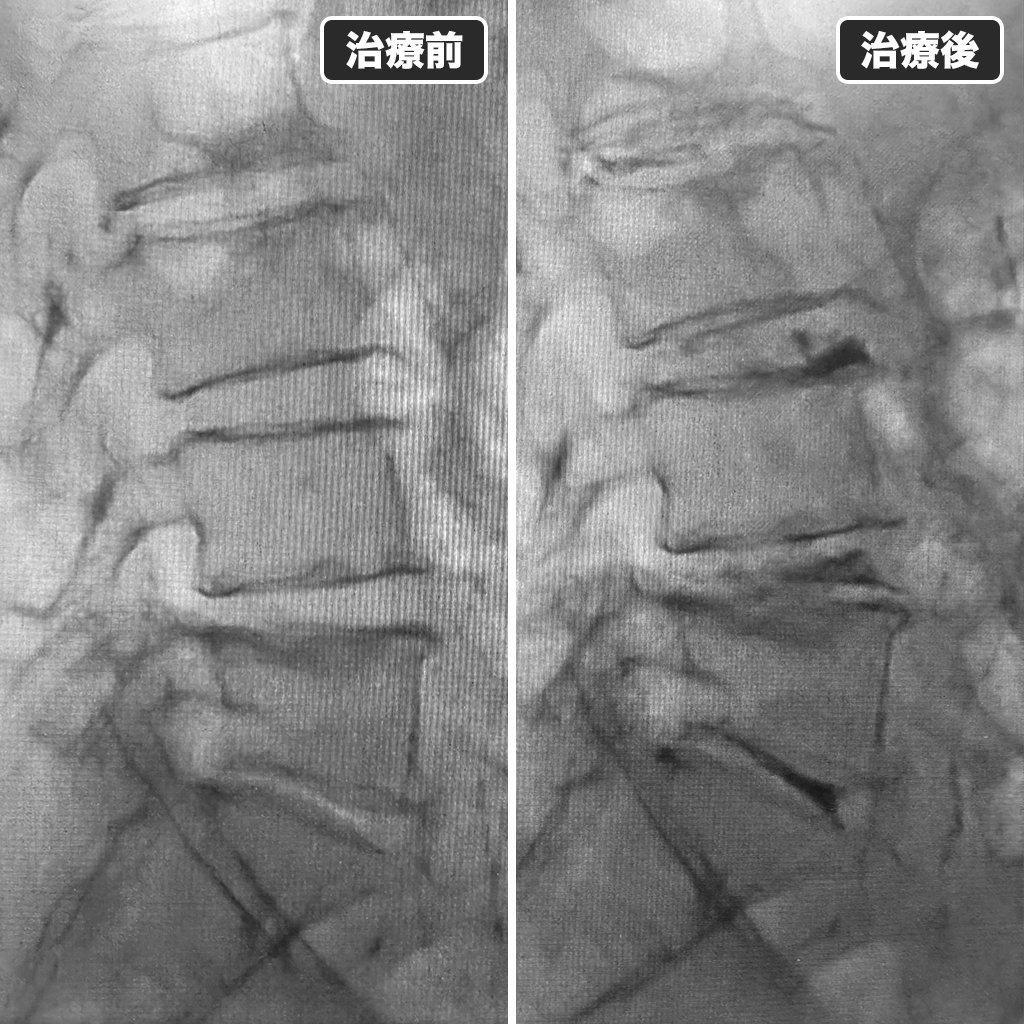 治療前後のレントゲン写真