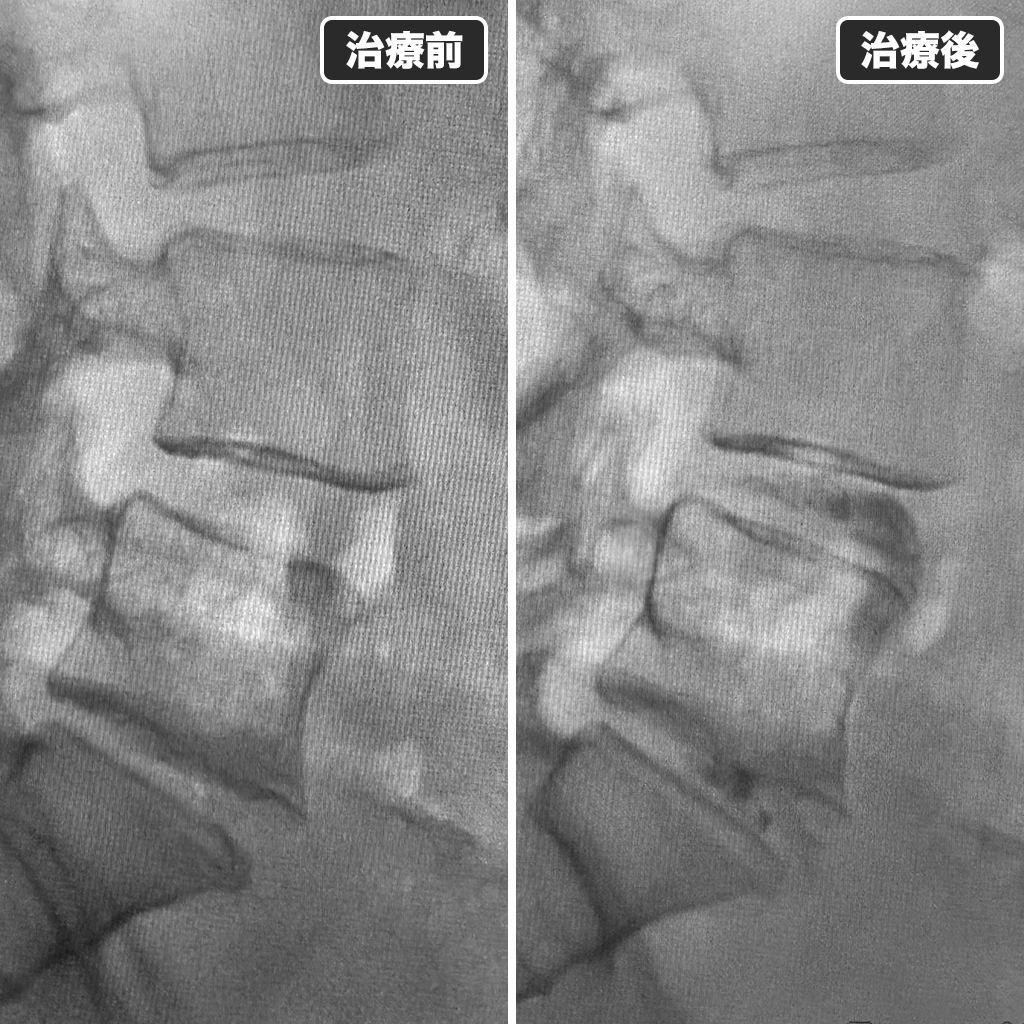 治療前後のレントゲン写真