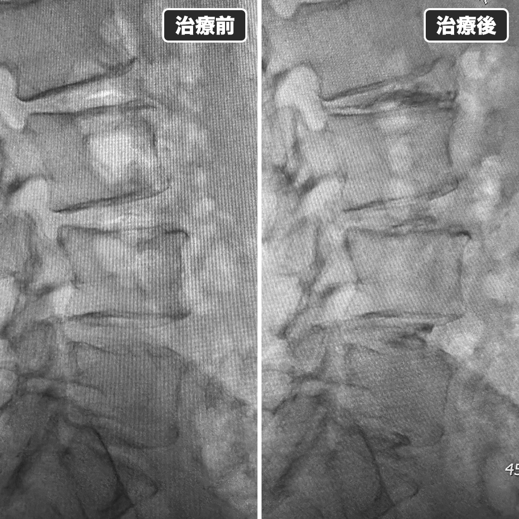 治療前後のレントゲン写真
