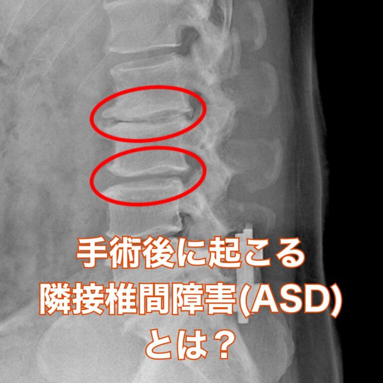 手術の「その後」に起きること — 隣接椎間障害（ASD）とは？ — 原因・治療・予防をわかりやすく解説