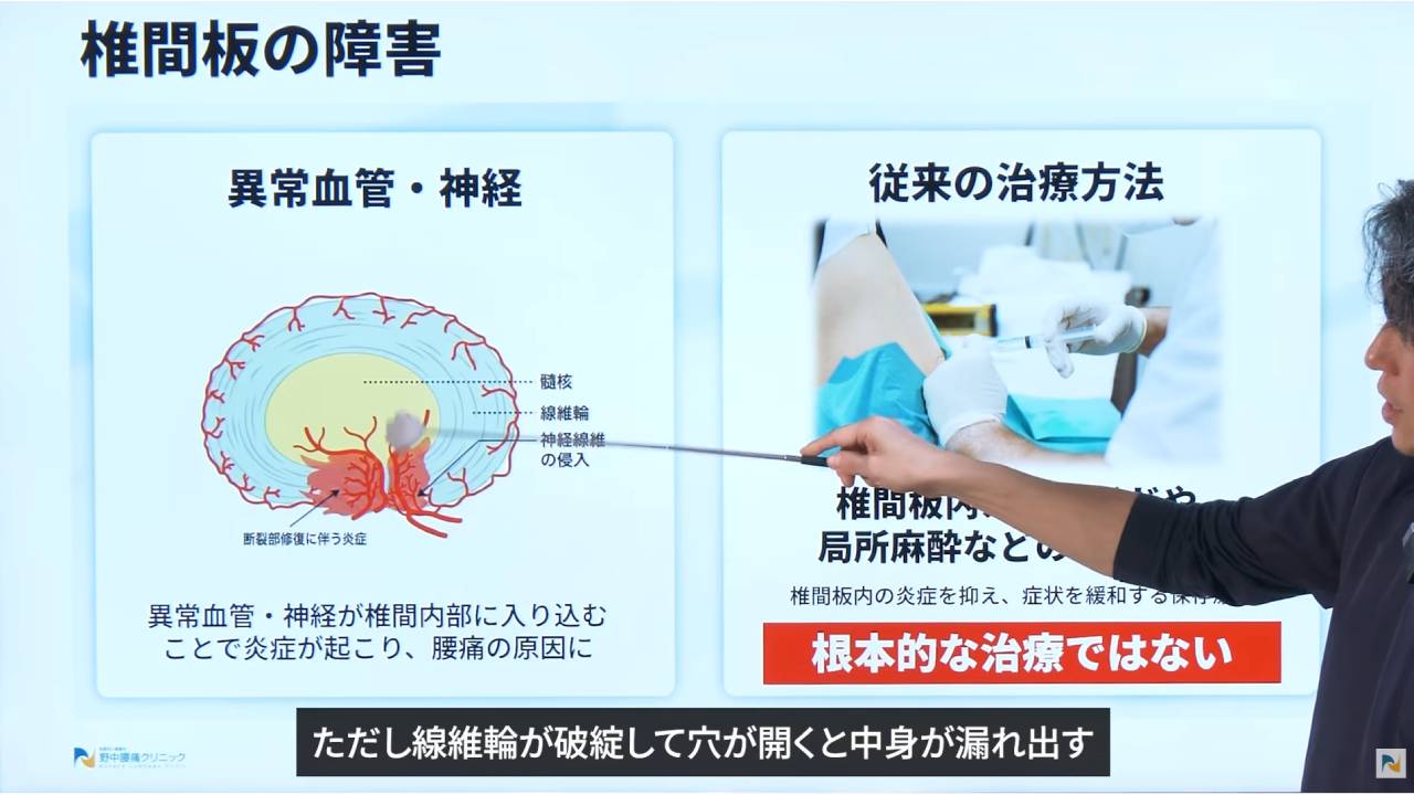 画像は線維輪の損傷の説明